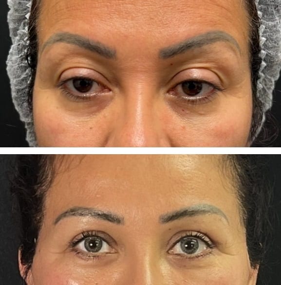 Cirugía de la Mirada caso 5 — antes y después
